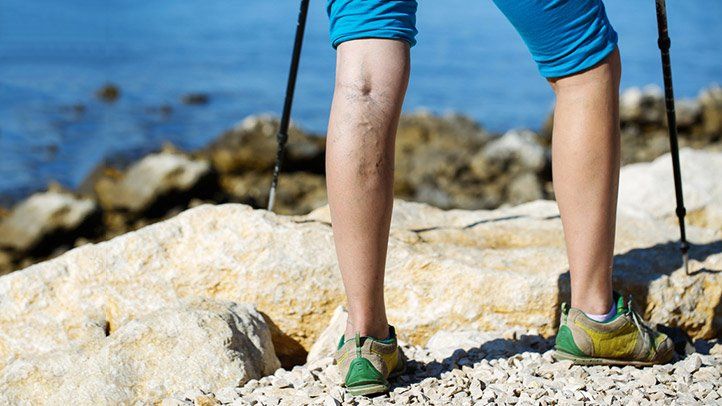 Some of the ultimate leg vein treatments to go for