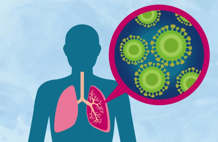 What Are the Treatments Regarding Pneumonia Disease?