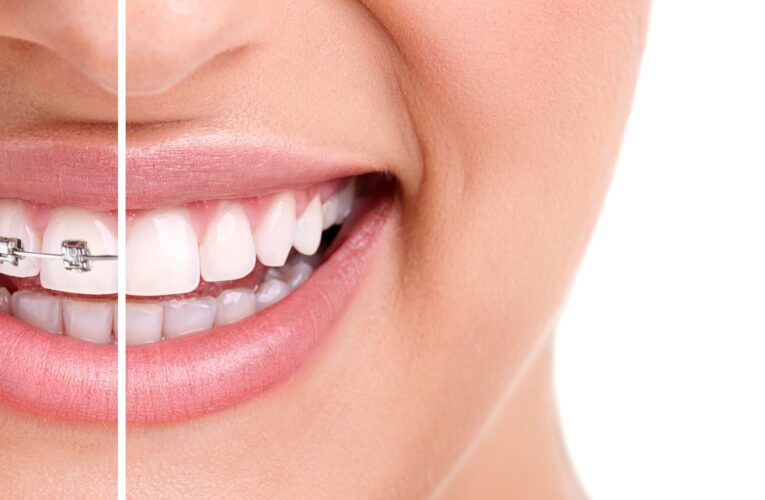 10 Tips For Getting The Best Invisalign Results